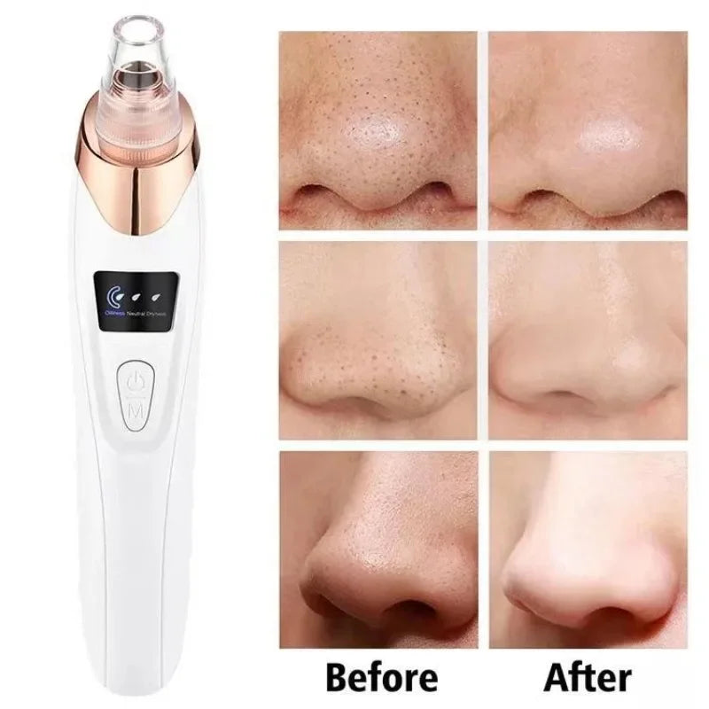 Electric Blackhead Remover
